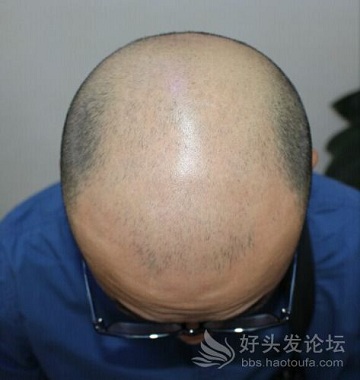  一位6级脱发者的植发“求生”历程