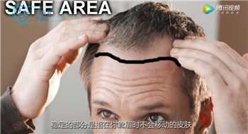 【植发原理】你需要知道的植发常识，植发究竟能将发际线下移多少？