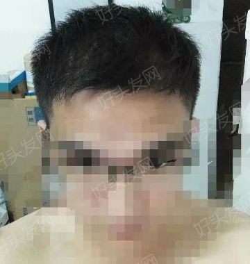 广州植发：前额三级脂溢性脱发