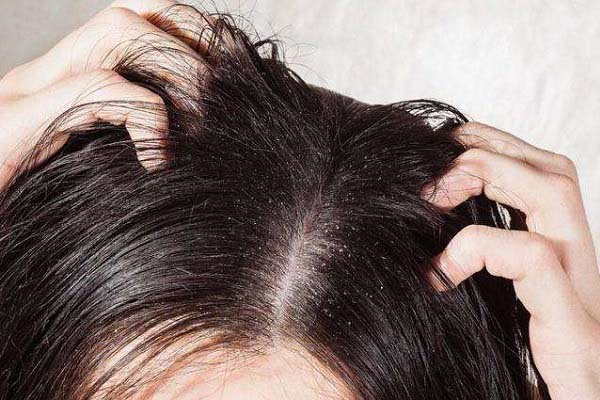 脂溢性皮炎也会导致脱发吗？	