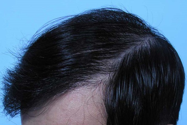 中医针灸对神经性脱发有效果吗