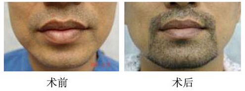胡须移植后多久能长出胡子