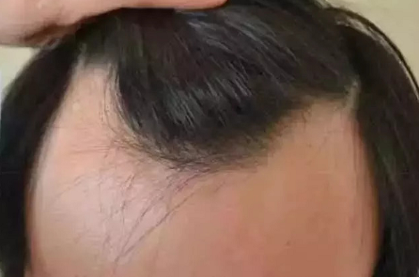 发际线植发有副作用吗