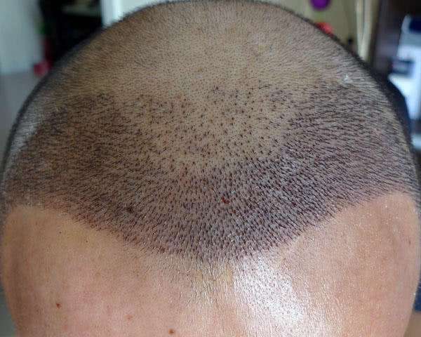 植发后应该如何洗头?