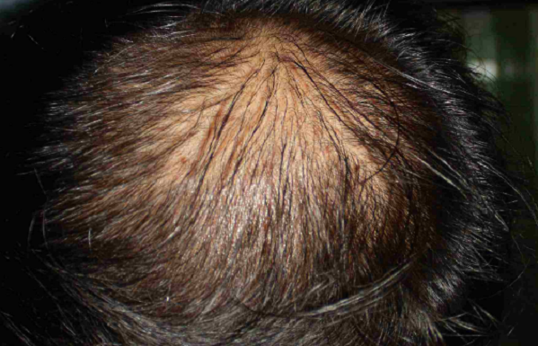 维生素B6,胱氨酸,鱼肝油一起吃可以治疗脱发吗