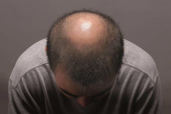 美国脱发人群都使用什么来治疗脱发