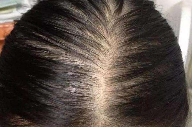 脂溢性脱发怎么治疗才有效，教你4大步骤治疗脂溢性脱发