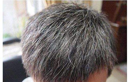 白发是什么原因? 深入解析白发原因，白发变黑发!