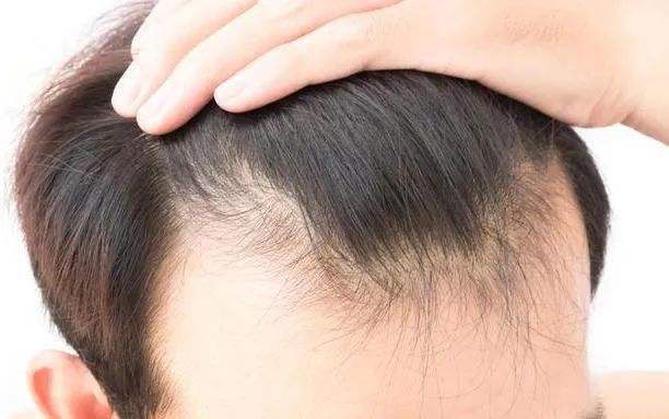 压力大对头发有什么危害?如何预防精神性脱发?