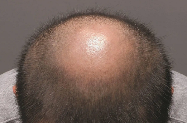男性脱发严重怎么治疗才有效 男士经常熬夜也会脱发吗