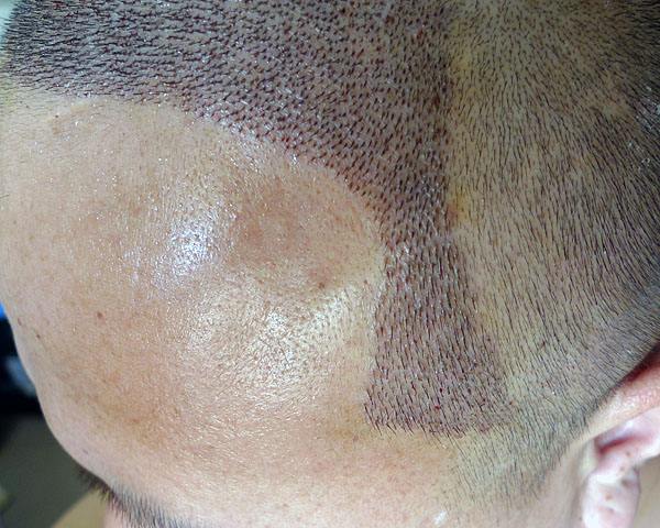 植发手术中存在的危害有哪些?
