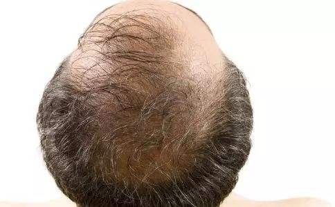 脱发严重怎么办?治疗秃顶的最好方法!