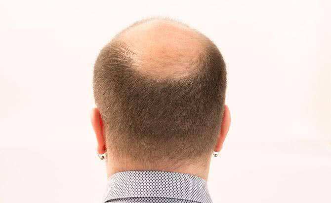 男人秃头是什么原因